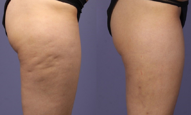 Doua ingrediente care lupta impotriva celulitei! Sigur le ai deja acasa